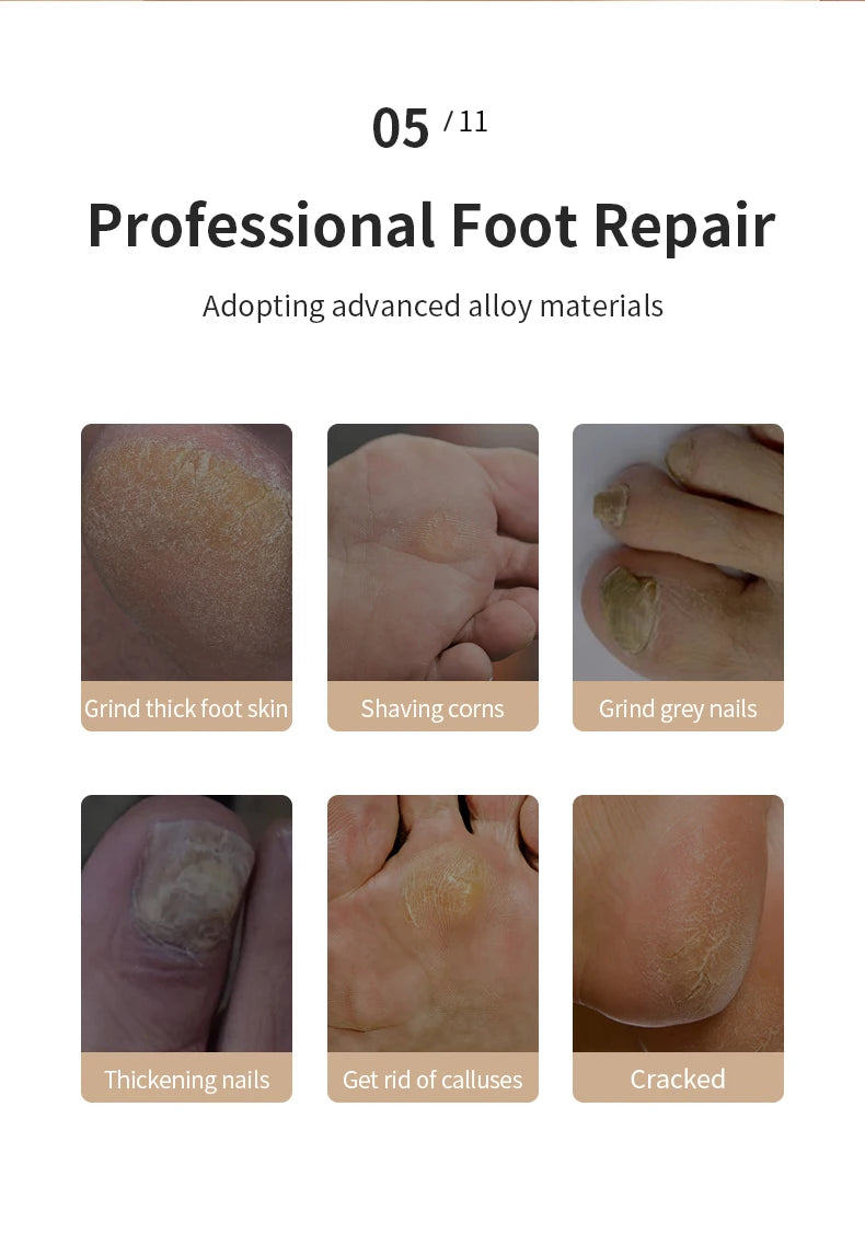 Professional foot repair with Rolli™ SmoothPro – showing feet only, highlighting removal of calluses, cracked skin, thick foot skin, corns, and grey or thickened nails