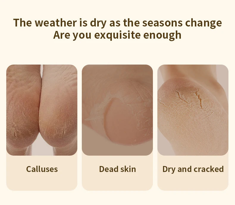 Close-up of feet showing dry, cracked skin, calluses, and dead skin – highlighting the need for Rolli™ SmoothPro electric foot file for smooth, soft feet